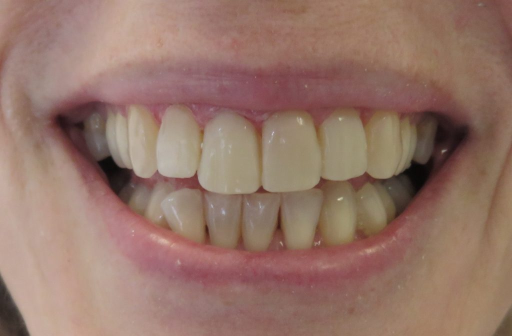 Best teeth whitening for bonded teeth